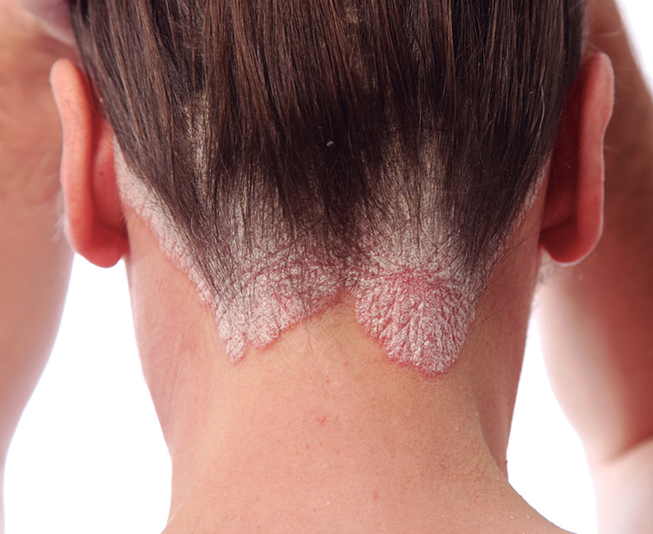 Que baños es necesario aceptar a la psoriasis