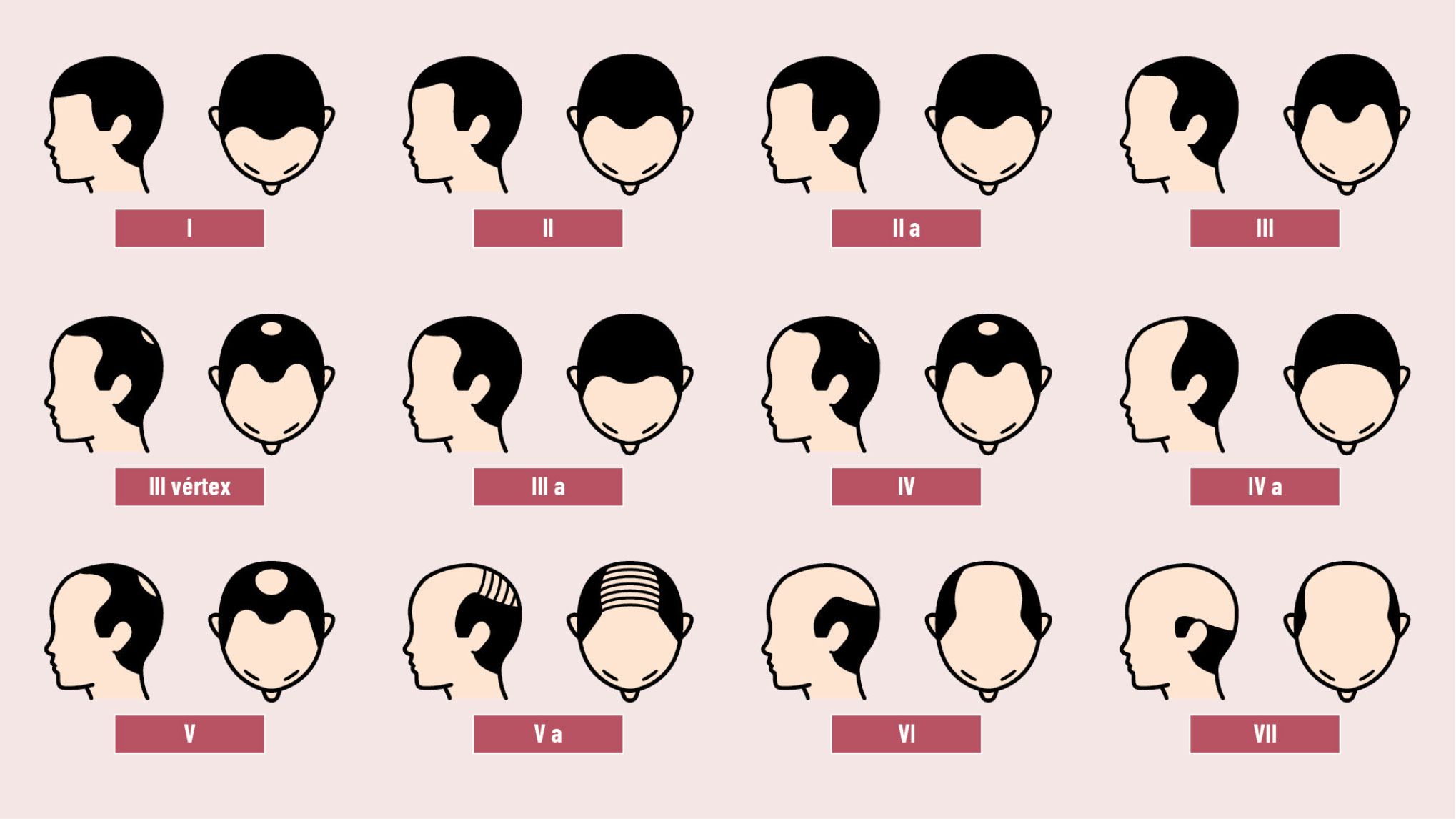 18 EF 601 TENDENCIAS te interesa alopecia figura 1