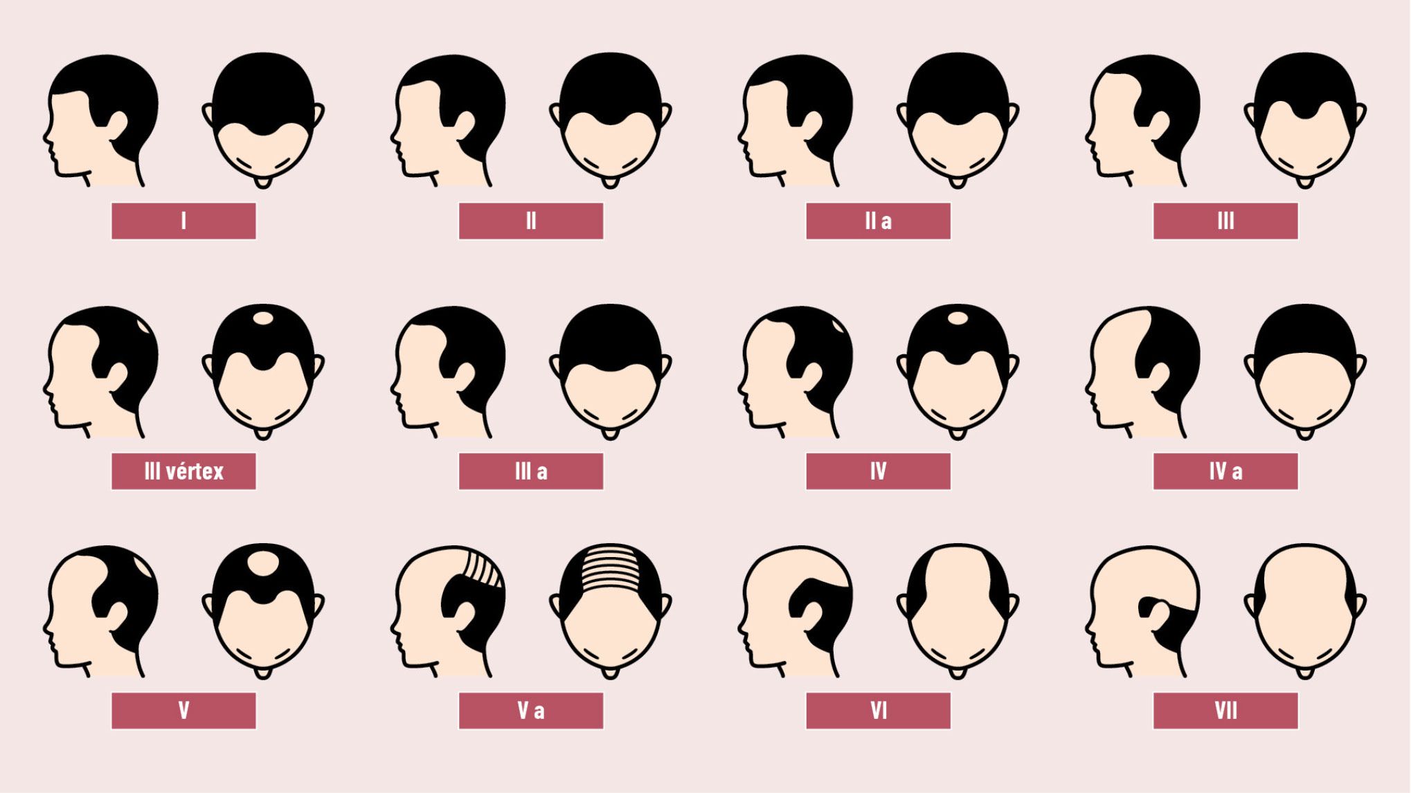 18 EF 601 TENDENCIAS te interesa alopecia figura 1 18 EF 601 TENDENCIAS te interesa alopecia figura 1