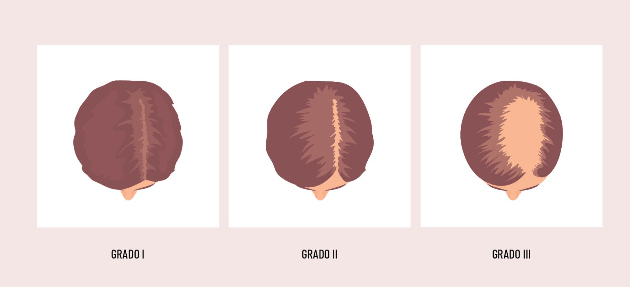 18 EF 601 TENDENCIAS te interesa alopecia figura 2 18 EF 601 TENDENCIAS te interesa alopecia figura 2
