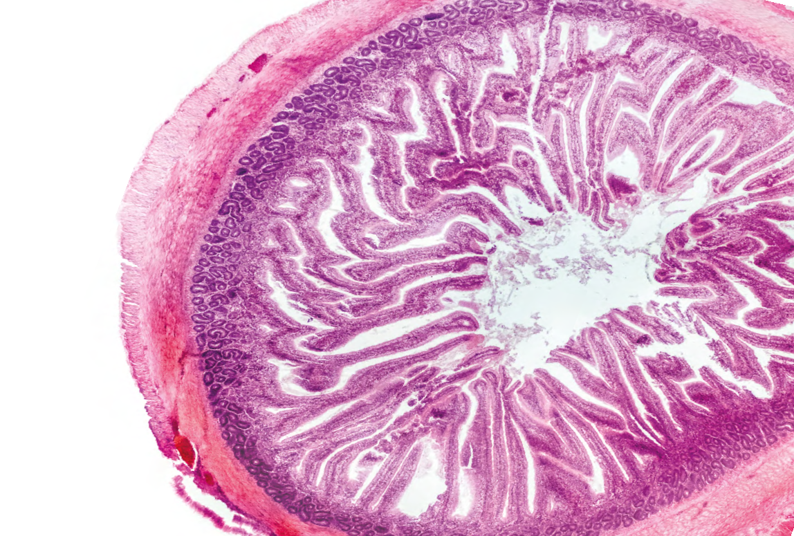 Risankizumab es un anticuerpo monoclonal que se trata del primer inhibidor selectivo de la IL-23/p19 en enfermedad de Crohn.