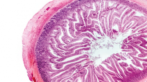Risankizumab es un anticuerpo monoclonal que se trata del primer inhibidor selectivo de la IL-23/p19 en enfermedad de Crohn.