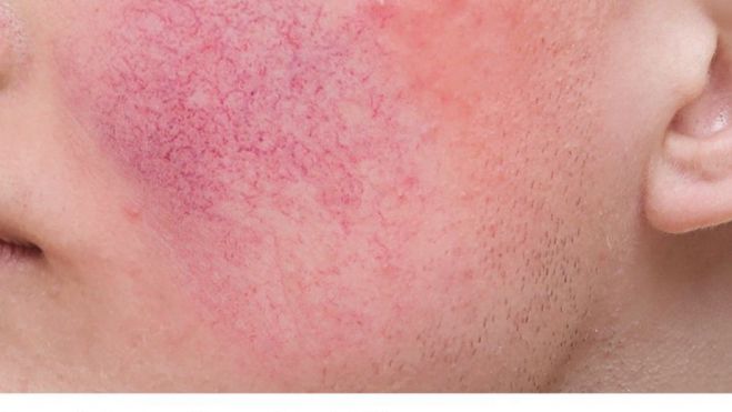 acne y rosacea Figura 3 acne y rosacea Figura 3