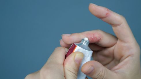 LEO Pharma introduce en España Anzupgo® (delgocitinib), el primer tratamiento tópico para el eccema crónico de manos grave