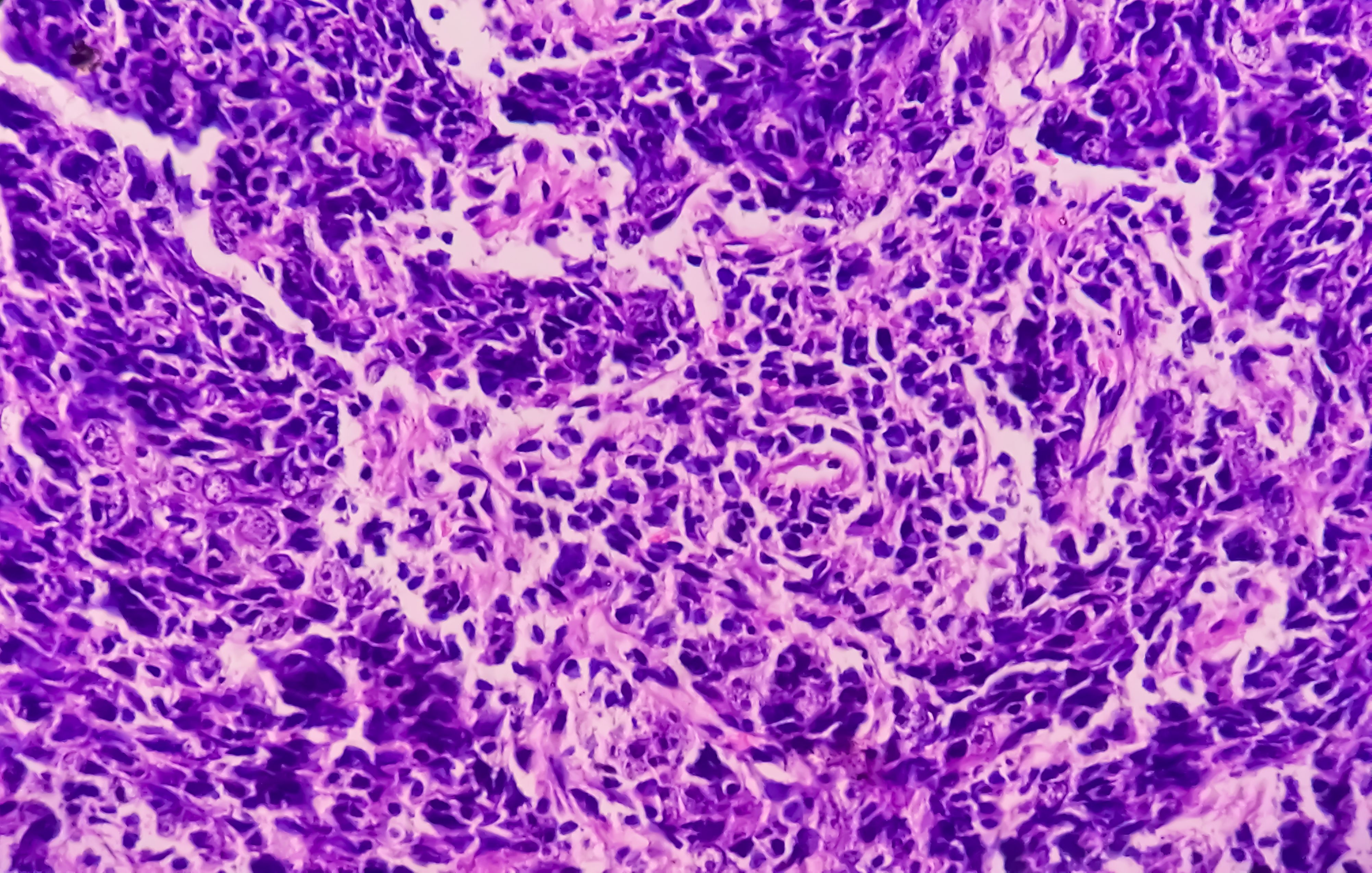 LEO Pharma lanza en España LOQTORZI®, un nuevo tratamiento de inmunoterapia para cáncer nasofaríngeo y esofágico avanzado