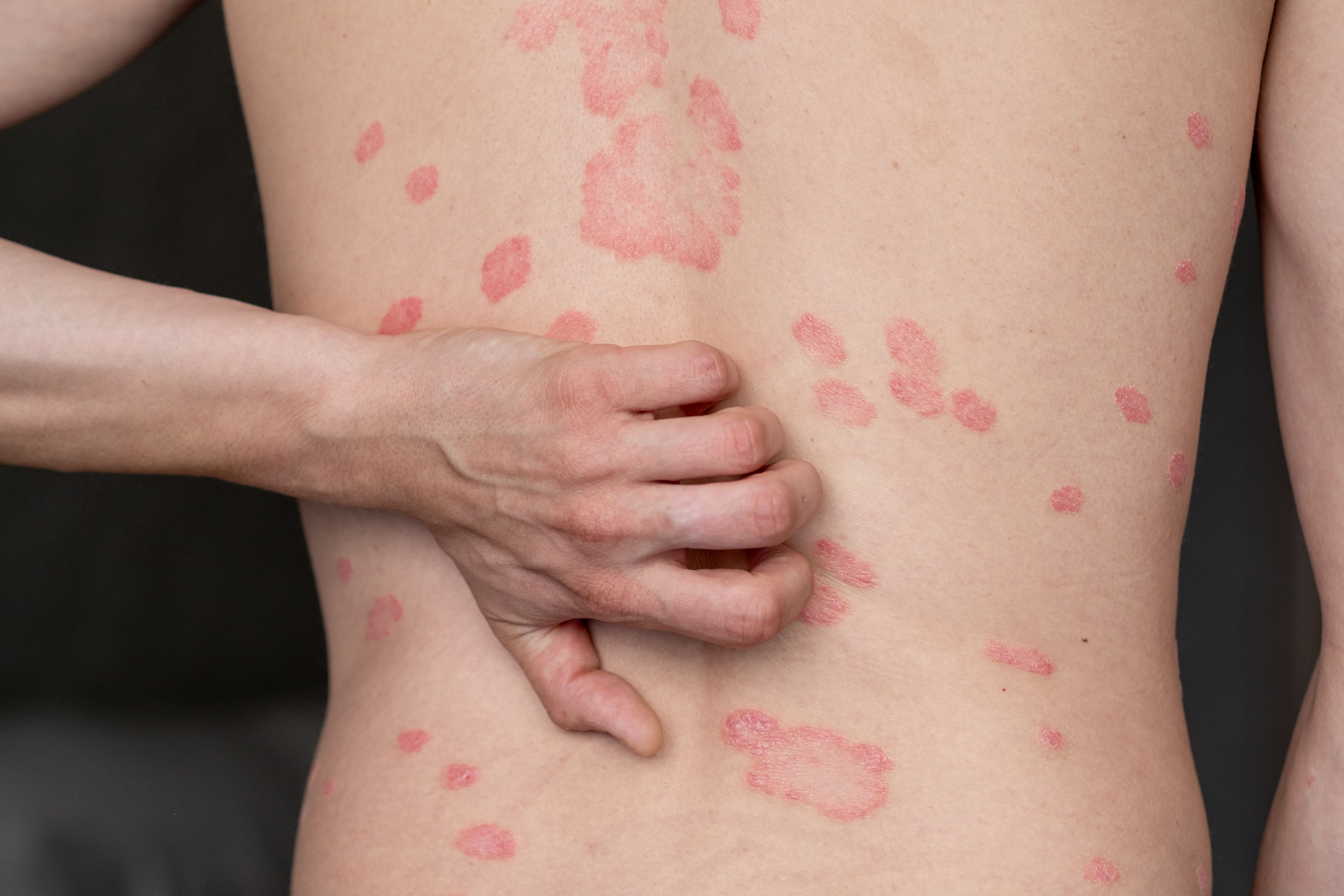 Zasocitinib supera a deucravacitinib en un estudio fase 3 y logra el aclaramiento completo de la piel en más de un tercio de los pacientes con psoriasis
