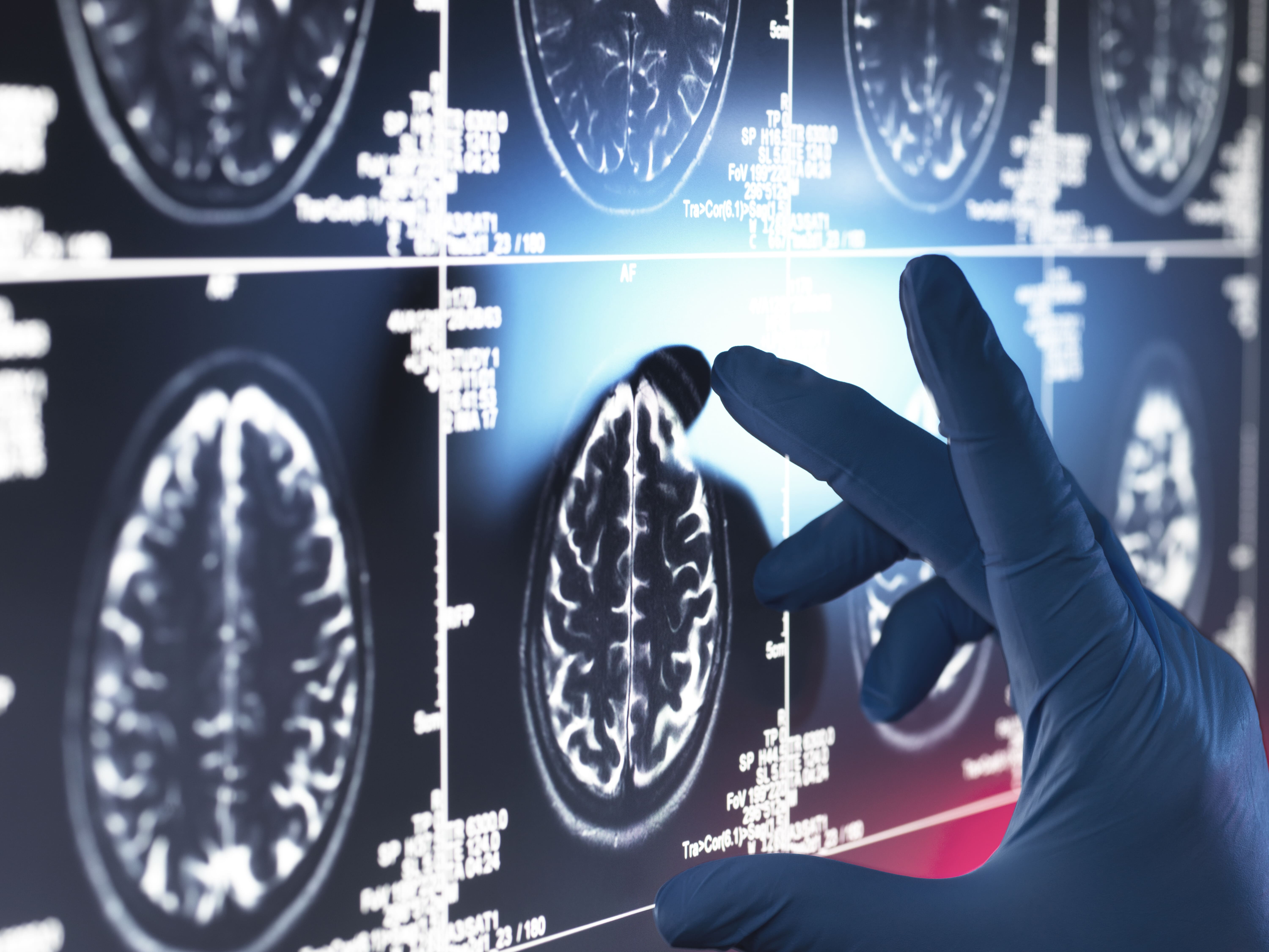 Teva amplía su apuesta por la Neurociencia con el lanzamiento en España de Perampanel Teva para la epilepsia