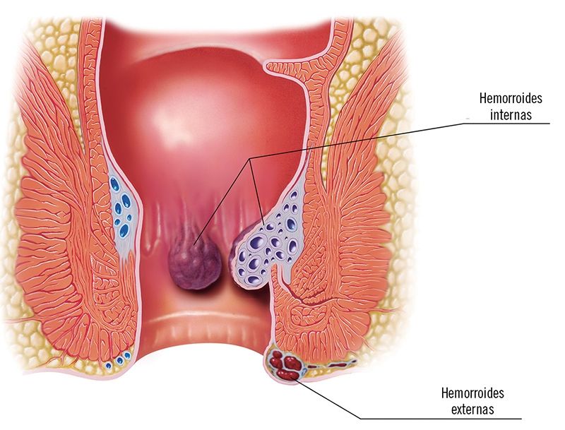 Enfermedad hemorroidal