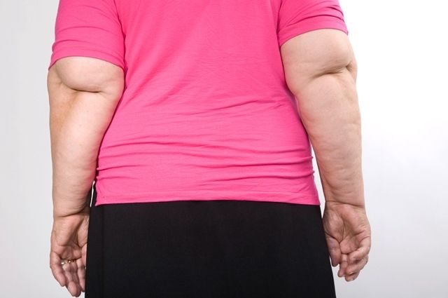 Paciente obesa de 65 años