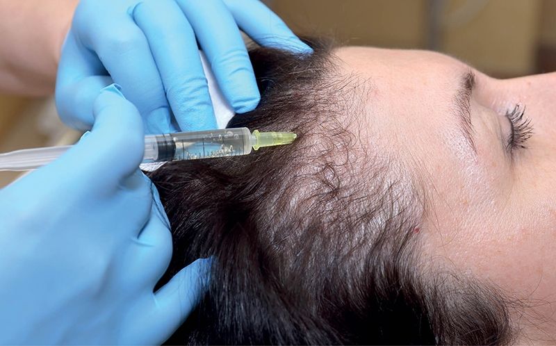 Caída del cabello: estrategias terapéuticas