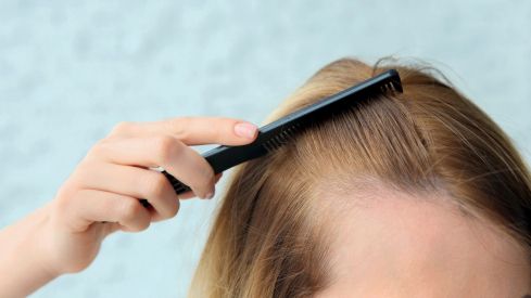 Alopecia posparto