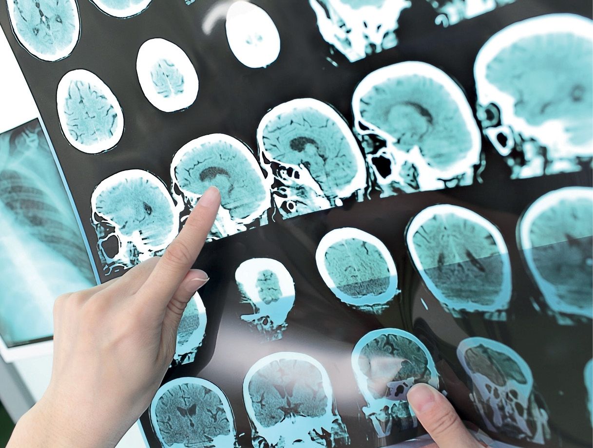 Módulo 4. Patologías cerebrovasculares