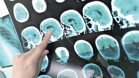 Módulo 4. Patologías cerebrovasculares