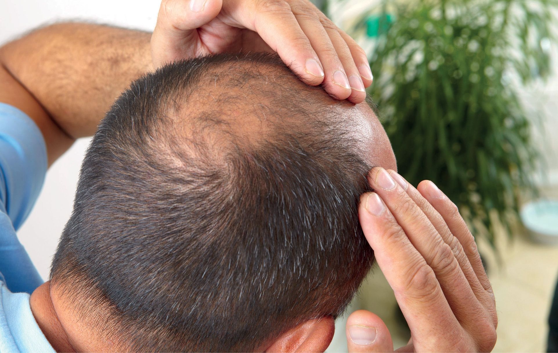 Introducción y fisiopatología de la caída del cabello