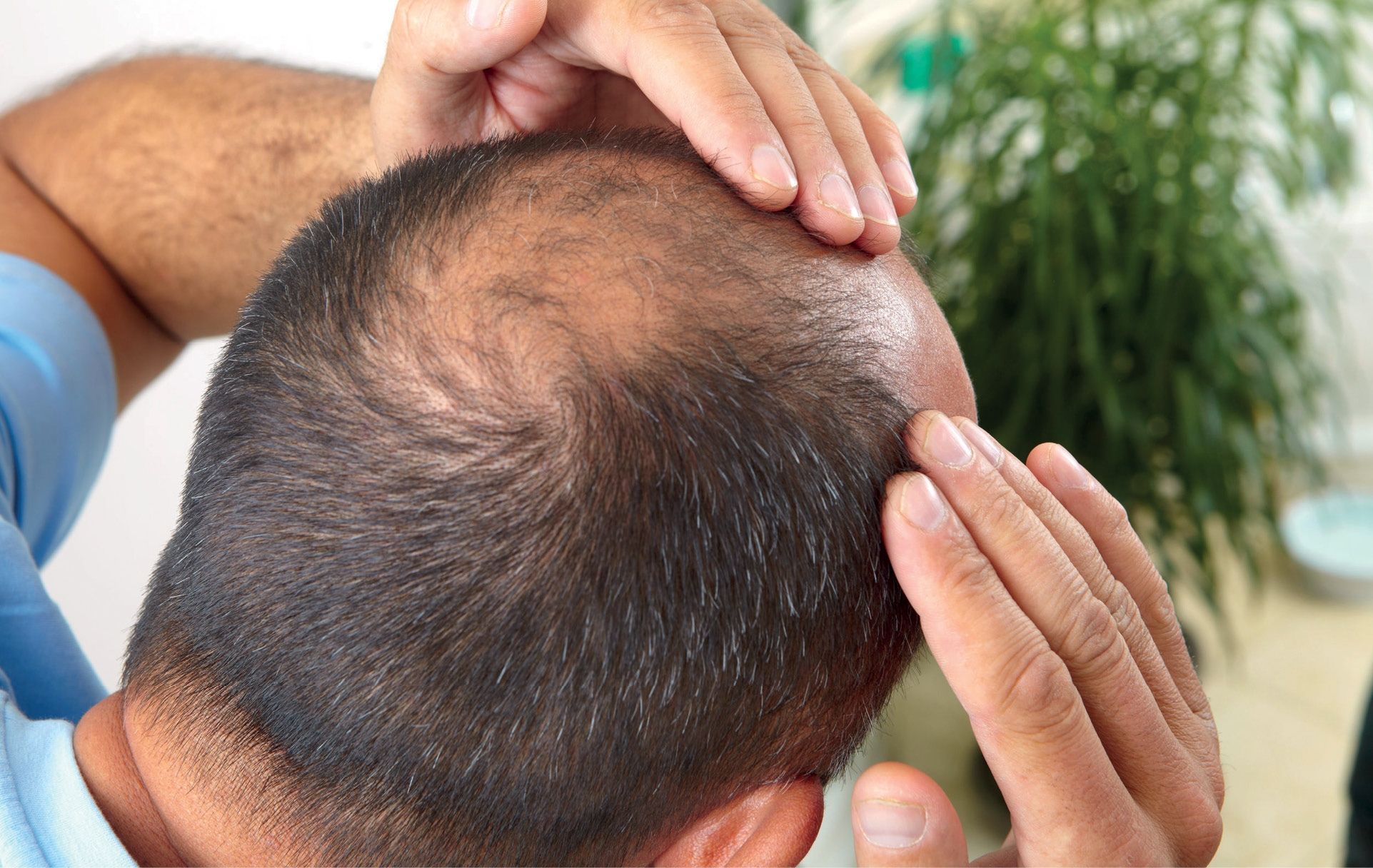 Tratamiento Preferencial a lo largo Profesor Introducción y fisiopatología de la caída del cabello